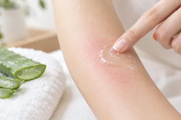 雷射除毛副作用:泛紅肌膚塗抹蘆薈膠